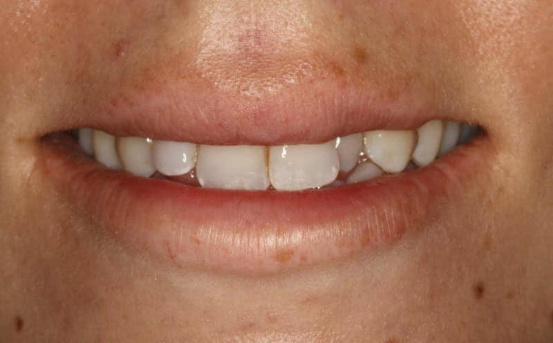 Teeth Whitening performed at home using bleaching trays - view before tooth whitening treatment cosmetic dentistry to improve your smile