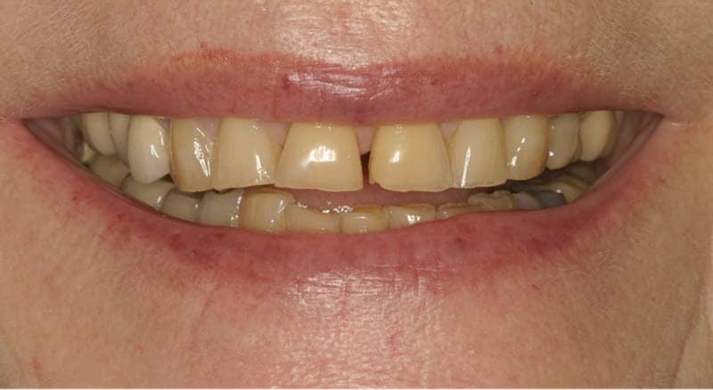 Power Whitening using cosmetic dentistry - before image 