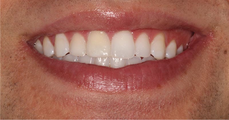 Manhattan Method for the whitening of smiles with multiple tooth shades after teeth whitening and bleaching