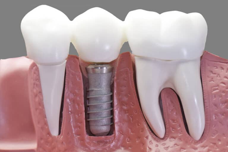 Model showing Divign implants using aligner treatment to improve dentistry and oral health - offered by The Manhattan Dentist