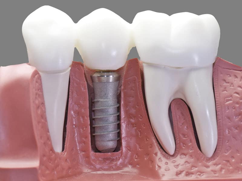 Natural - Imagine No Oral Surgery -Tinnisense dental implants - avoid wisdom tooth removal or tooth extraction with affordable dental implant low cost option