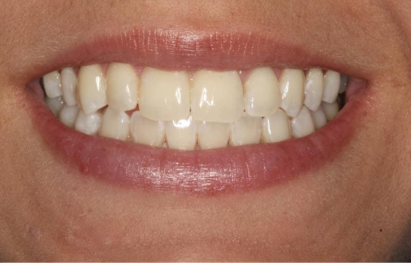 This image shows cosmetic dentistry patient with an improved smile after in-office treatment