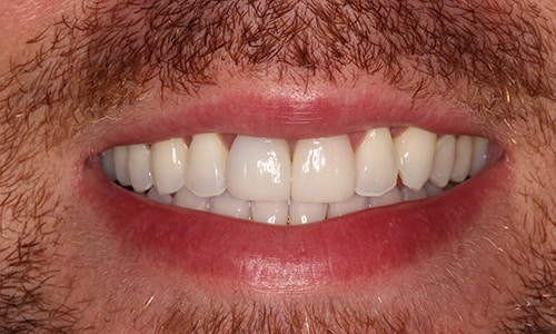 Award winning real dental patient smile - fixed with Tinnisense - top porcelain veneers - best NY dentist