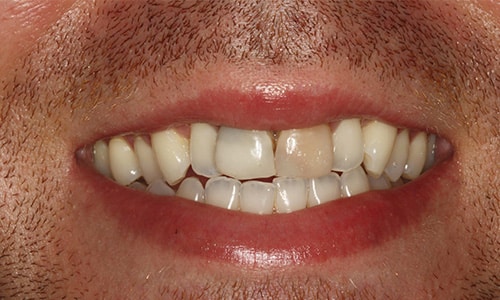 This award winning real dental patient had a very bad  bite and smile fixed with Tinnisense veneers and whitening