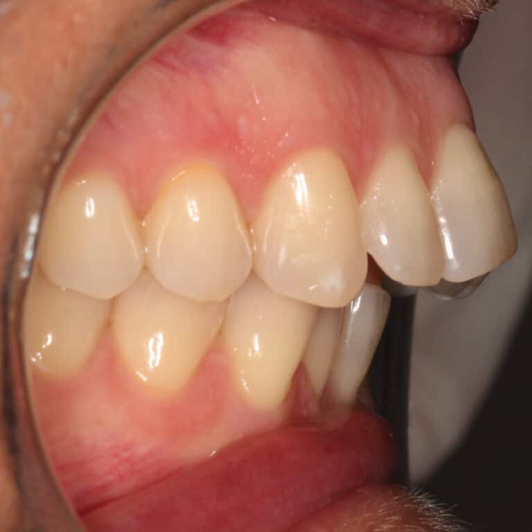 Before treatment by the best Divign Invisalign orthodontic dentist, orthodontist, no wisdom tooth removed