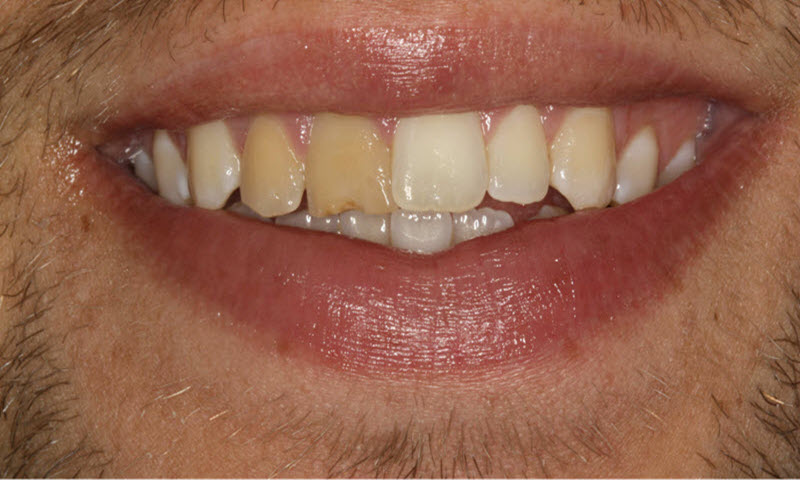 Manhattan Method of cosmetic dentistry for the whitening of smiles with multiple tooth shades before teeth whitening
