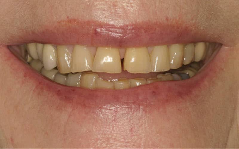 Power Whitening using cosmetic dentistry with bleaching- before image