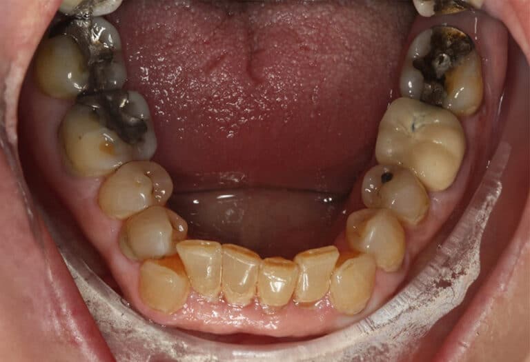 View of patient mouth - this tinnitus sufferer received excellent tinnitus-focused therapy using Tinnisense aligners.